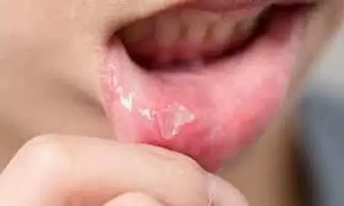 mouth ulcers