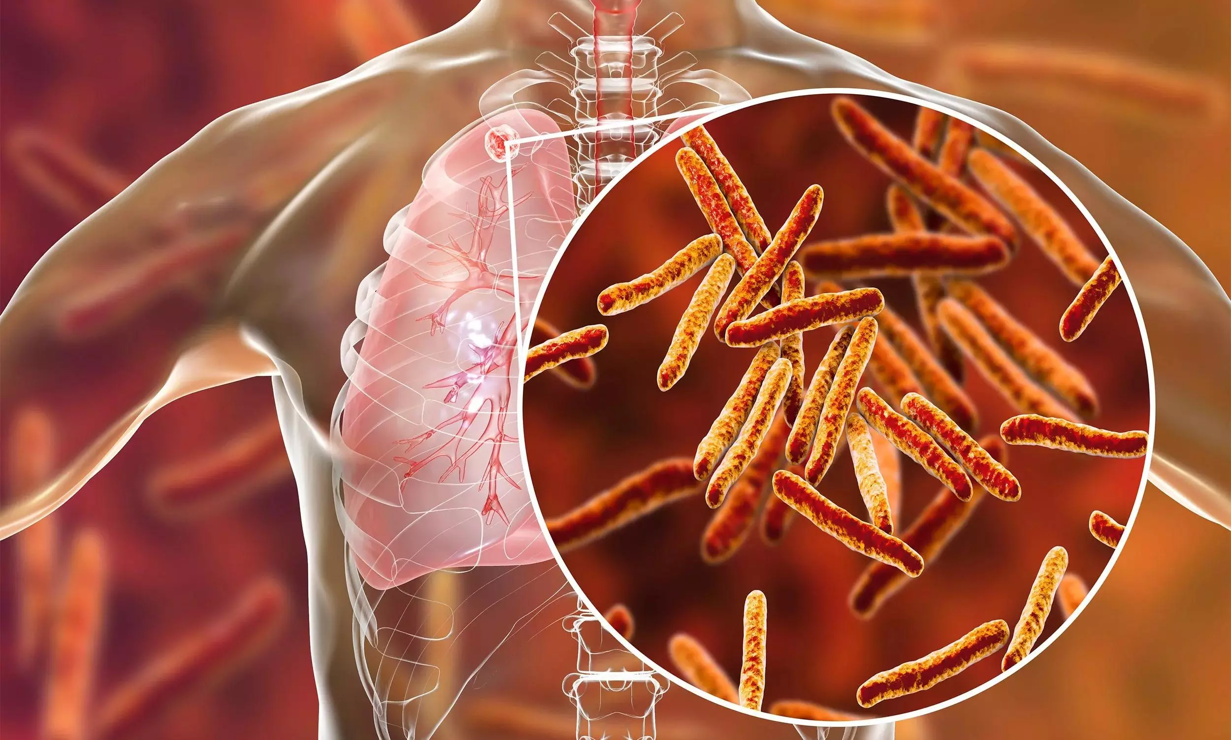 From killer to rescuer: the molecular revolution and AI era in TB prevention From killer to rescuer: the molecular revolution and AI era in TB prevention