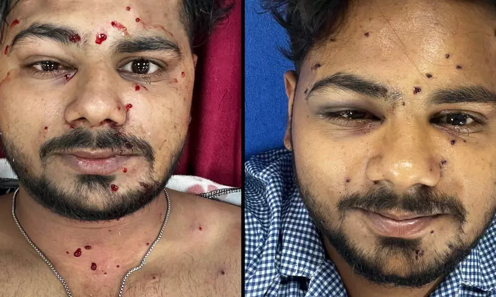 Protester undergoes three surgeries to remove pellet-like objects as Delhi Police deny using pellet guns Protester undergoes three surgeries to remove pellet-like objects as Delhi Police deny using pellet guns