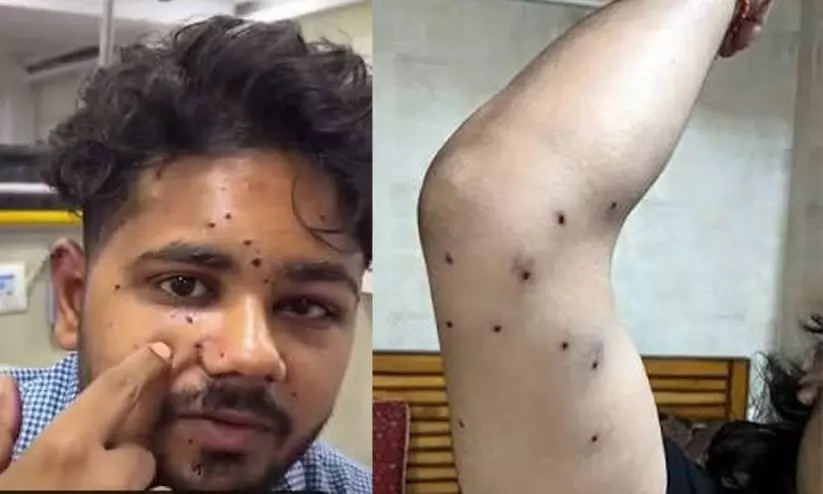 Pellet attack in CJP protest: 19-year-old may lose vision Pellet attack in CJP protest: 19-year-old may lose vision