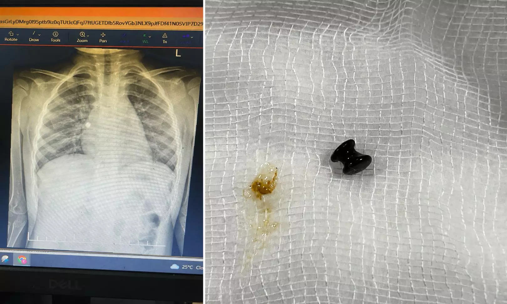 Toddler inhales toy pearl; doctors at VPS Lakeshore Hospital save her Toddler inhales toy pearl; doctors at VPS Lakeshore Hospital save her