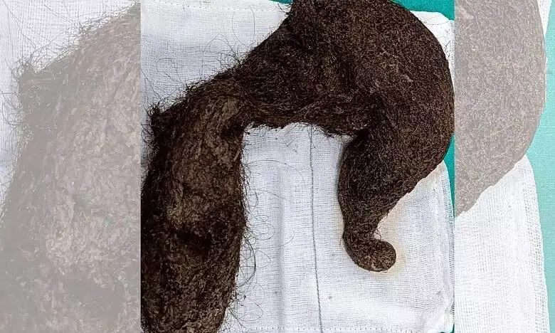 Delhi doctors remove 1.16-kg hairball from 20-year-old who ate hair for 11 years Delhi doctors remove 1.16-kg hairball from 20-year-old who ate hair for 11 years